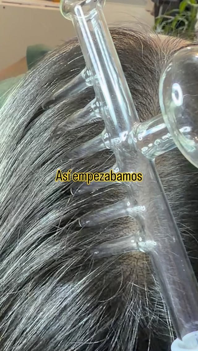 Electrodo de alta frecuencia sobre el cuero cabelludo
