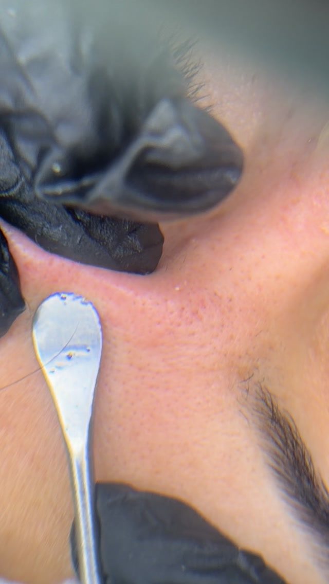 Extracciones en una limpieza facial